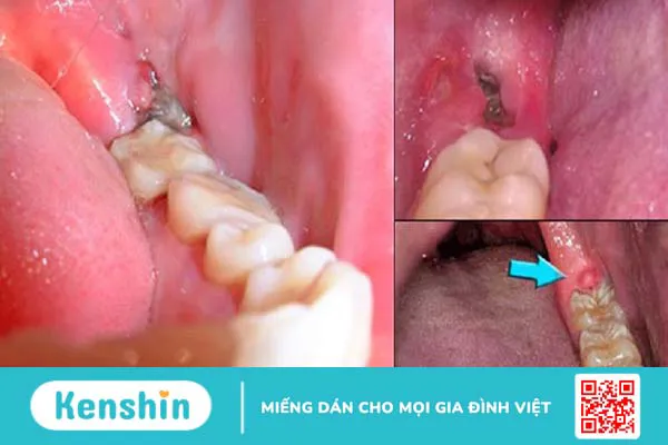 Vì sao nhổ răng khôn 3 ngày vẫn đau? Cách khắc phục là gì?