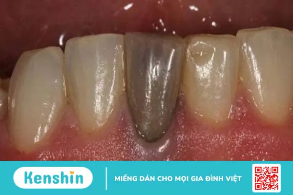 Vì sao răng chết tủy đổi màu? Phương pháp điều trị răng bị chết tủy