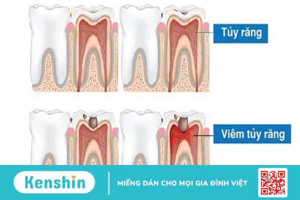 Vì sao răng chết tủy đổi màu? 1