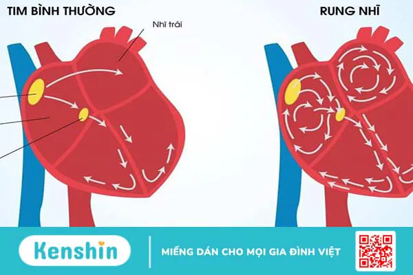 Vì sao rung nhĩ gây huyết khối? Các loại thuốc chống đông dùng trong rung nhĩ