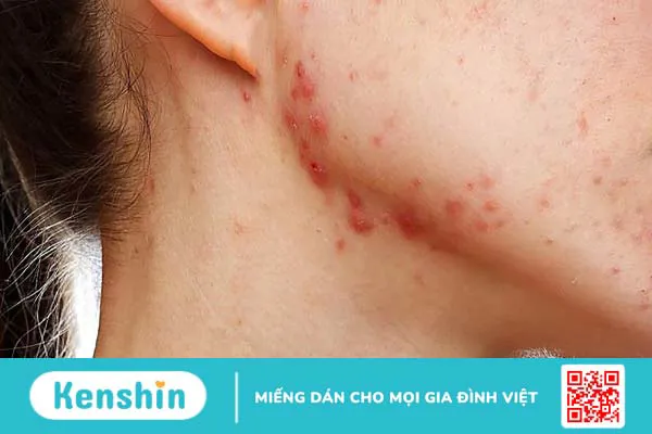 Vì sao uống thải độc gan bị nổi mụn?