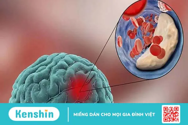 Vị trí xuất huyết não nguy hiểm nhất ở đâu và cách điều trị 3