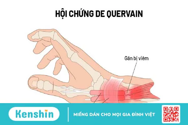 Viêm bao gân mỏm trâm quay cổ tay: Nguyên nhân, chẩn đoán và điều trị