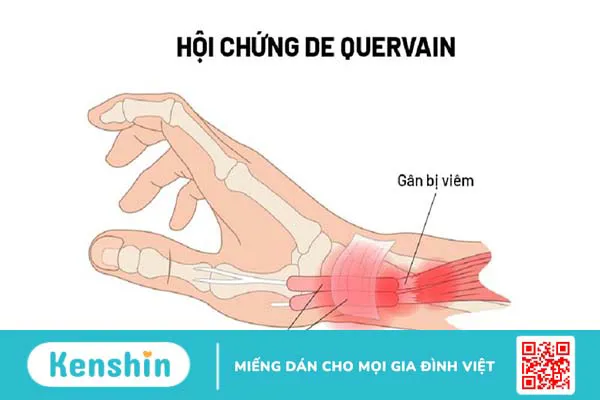 Viêm bao gân mỏm trâm quay cổ tay: Nguyên nhân, chẩn đoán và điều trị