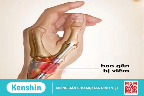 Viêm bao gân mỏm trâm quay cổ tay: Nguyên nhân, chẩn đoán và điều trị