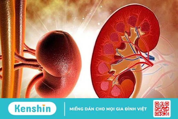 Viêm cầu thận có nguy hiểm không? Điều trị viêm cầu thận thế nào?