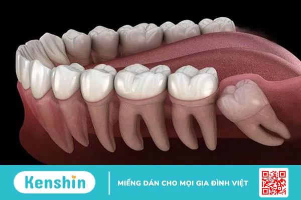 Viêm cơ cắn vùng hàm mặt là gì, dấu hiệu nhận biết viêm cơ cắn 2