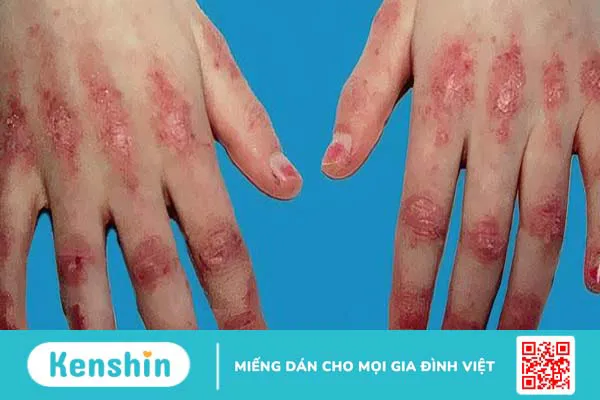 Viêm cơ tự miễn có nguyên nhân do đâu? Triệu chứng, chẩn đoán và điều trị