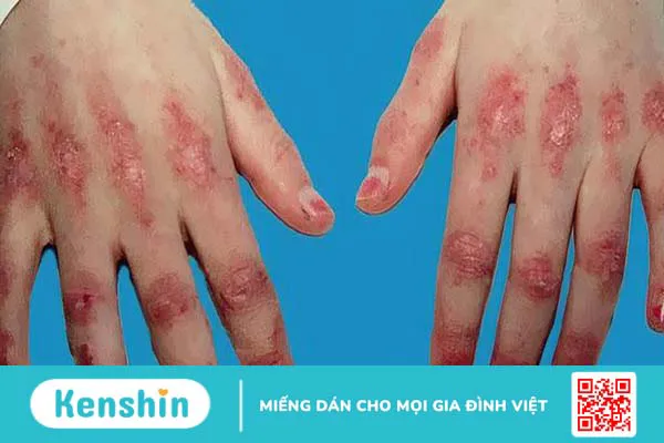 Viêm cơ tự miễn có nguyên nhân do đâu? Triệu chứng, chẩn đoán và điều trị 1