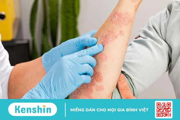 Viêm cơ tự miễn có nguyên nhân do đâu? Triệu chứng, chẩn đoán và điều trị 2