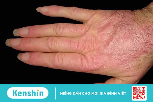 Viêm cơ tự miễn có nguyên nhân do đâu? Triệu chứng, chẩn đoán và điều trị 3