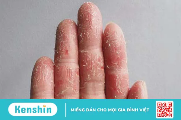 Viêm da cơ địa mất vân tay: Nguyên nhân, triệu chứng và cách điều trị