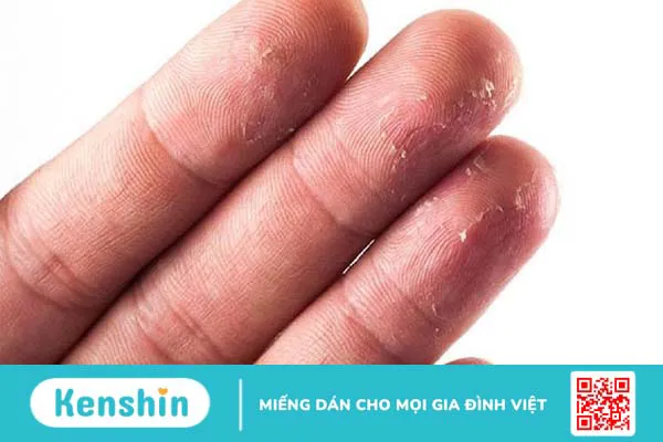 Viêm da cơ địa mất vân tay: Nguyên nhân, triệu chứng và cách điều trị 2