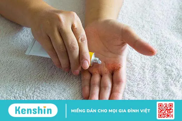 Viêm da cơ địa mất vân tay: Nguyên nhân, triệu chứng và cách điều trị 3