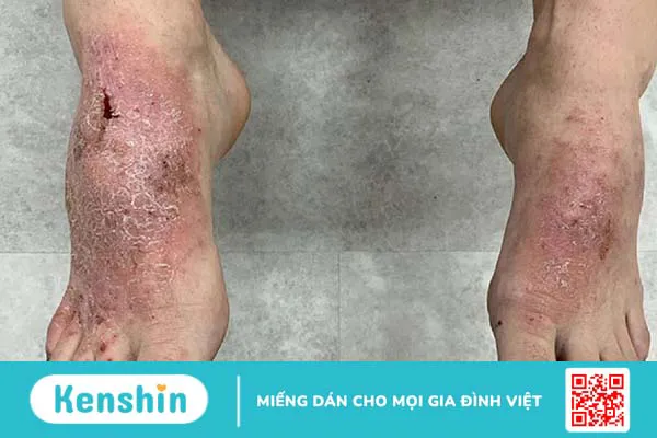 Viêm da cơ địa ở chân là gì? Cách nhận biết và điều trị bằng Đông y 3