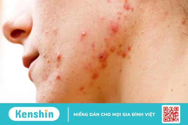 Viêm da mủ kiêng ăn gì nhanh khỏi?