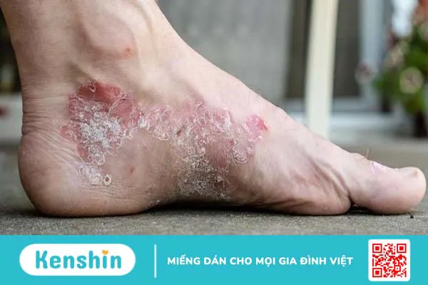 Viêm da mủ kiêng ăn gì nhanh khỏi?