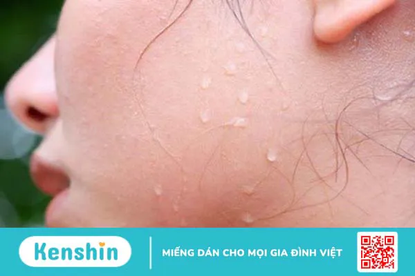 Viêm da mủ kiêng ăn gì nhanh khỏi?