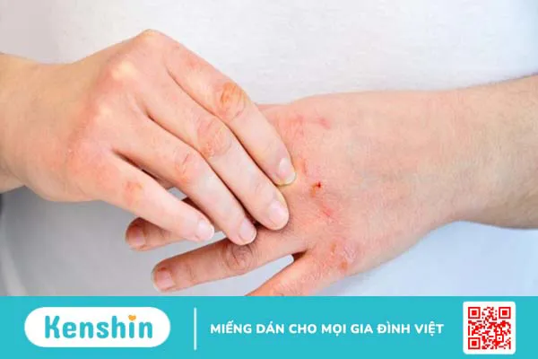 Viêm da tiếp xúc có lây không? Phương pháp điều trị viêm da tiếp xúc