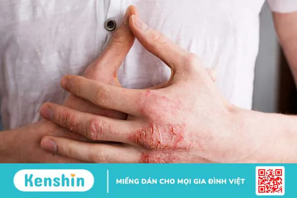 Viêm da tiếp xúc có lây không? Phương pháp điều trị viêm da tiếp xúc