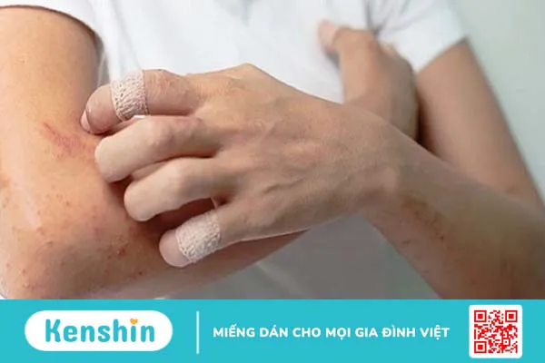 Viêm da tiếp xúc có lây không? Phương pháp điều trị viêm da tiếp xúc