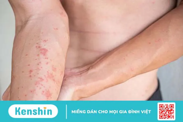 Viêm da tiếp xúc có lây không? Phương pháp điều trị viêm da tiếp xúc