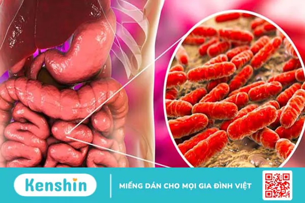 Viêm đại tràng vi thể là bệnh gì? Nguyên nhân và cách điều trị