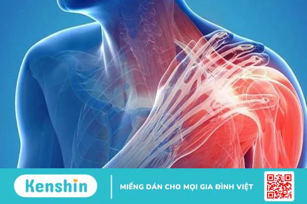 Viêm gân cơ trên gai: Nguyên nhân, triệu chứng, chẩn đoán và điều trị 1