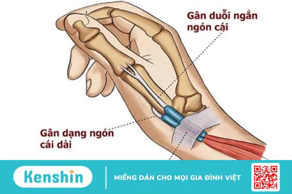 Viêm gân duỗi ngón cái: Nguyên nhân, triệu chứng, chẩn đoán và điều trị 3