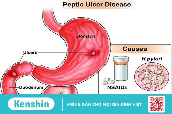 Viêm loét dạ dày uống nước gì và tránh ăn gì?