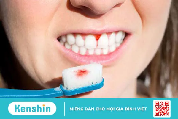 Viêm lợi có ăn được rau muống không?