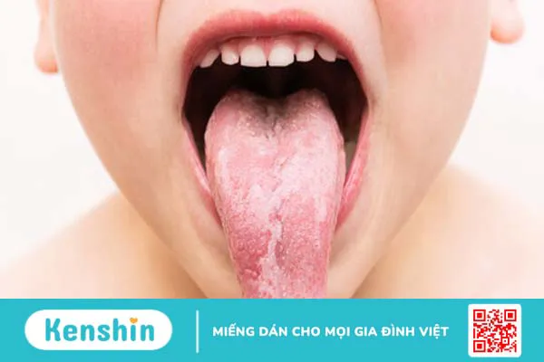 Viêm lưỡi bản đồ có nguy hiểm không?