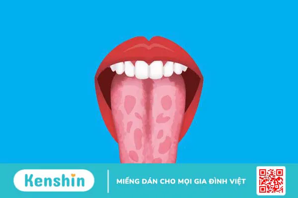 Viêm lưỡi bản đồ có nguy hiểm không?