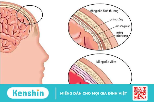 Viêm màng não do não mô cầu: Giải đáp các câu hỏi thường gặp cùng bác sĩ Nguyễn Văn My