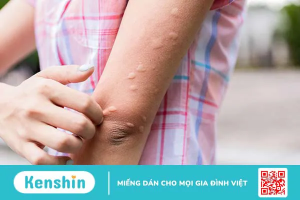 Viêm màng não do não mô cầu: Giải đáp các câu hỏi thường gặp cùng bác sĩ Nguyễn Văn My