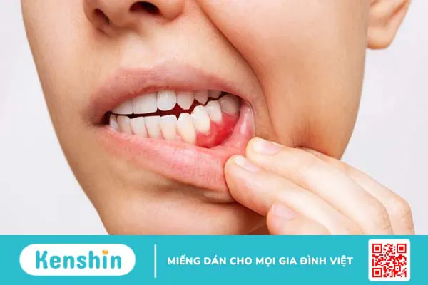 Viêm nha chu bao lâu thì khỏi? Cách chữa viêm nha chu nhanh khỏi