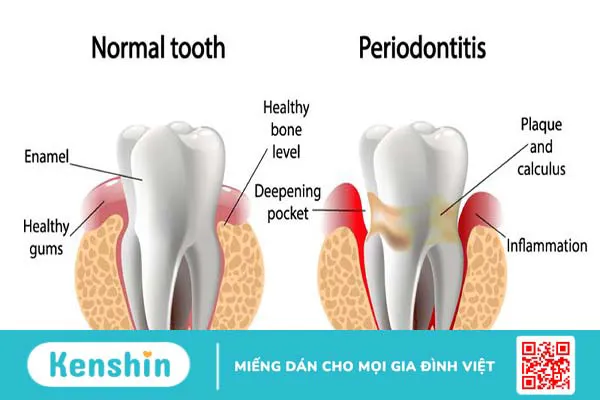 Viêm nha chu bao lâu thì khỏi? Cách chữa viêm nha chu nhanh khỏi 1