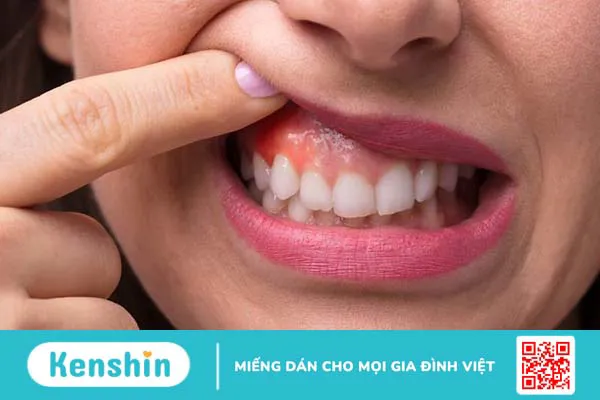 Viêm nha chu bao lâu thì khỏi? Cách chữa viêm nha chu nhanh khỏi 3