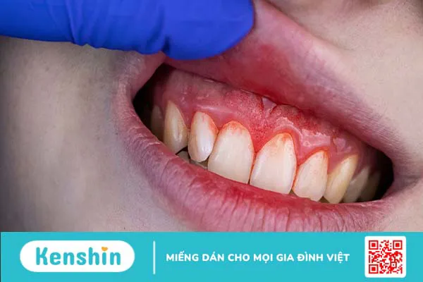 Viêm nha chu nặng có thể dẫn đến biến chứng nguy hiểm gì?