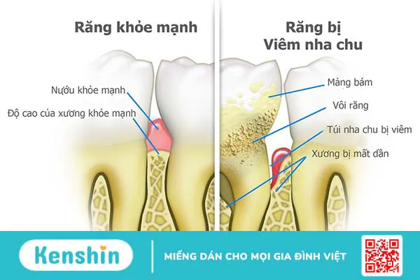 Viêm nha chu nặng có thể dẫn đến biến chứng nguy hiểm gì?