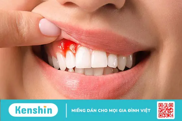 Viêm nướu răng có bị sốt không? Vì sao viêm nướu răng kèm sốt?