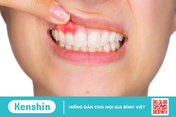 Viêm nướu răng có bị sốt không? Vì sao viêm nướu răng kèm sốt?