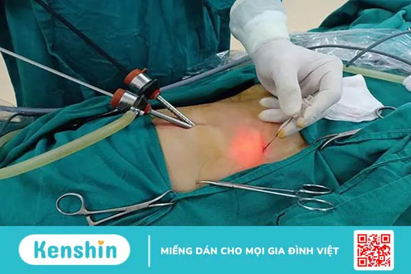 Viêm túi mật do sỏi: Căn bệnh nguy hiểm, có thể gây tử vong 3