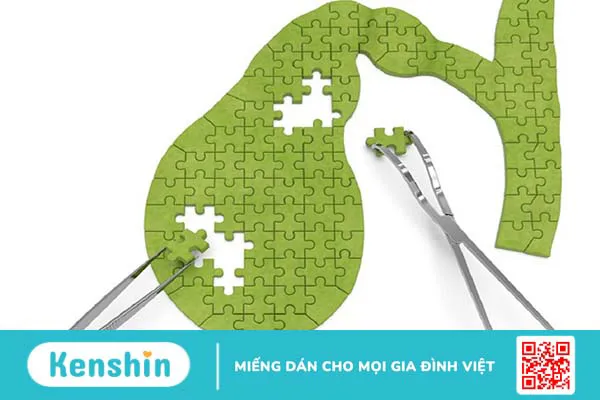 Viêm túi mật không do sỏi: Triệu chứng, chẩn đoán và điều trị 1