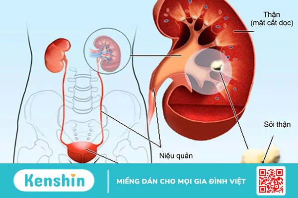 Viên uống Stonix-F 30V: Trợ thủ đắc lực hỗ trợ điều trị sỏi thận 1