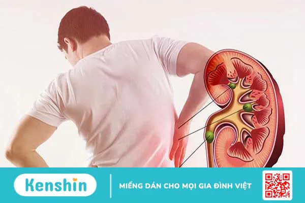 Viên uống Stonix-F 30V: Trợ thủ đắc lực hỗ trợ điều trị sỏi thận 2