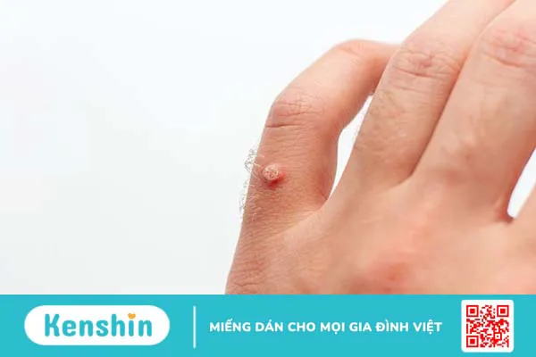 Virus HPV ở nam giới: Tầm soát và phòng ngừa