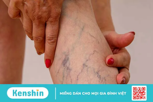 Vớ Biohealth compression I và hiệu quả hỗ trợ chống giãn tĩnh mạch chân