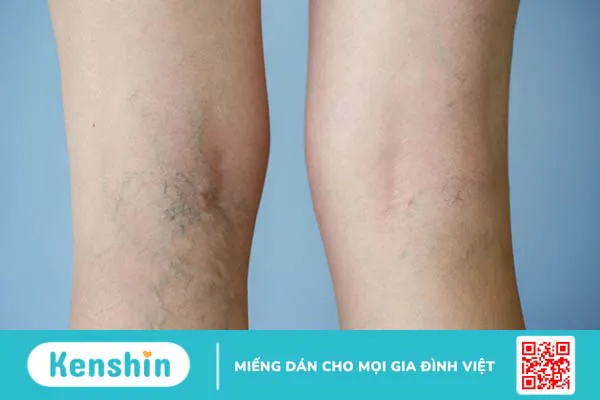 Vớ Biohealth compression I và hiệu quả hỗ trợ chống giãn tĩnh mạch chân