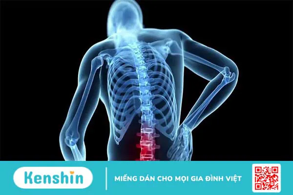 Vôi hóa cột sống thắt lưng: Nguyên nhân, triệu chứng và cách điều trị hiệu quả 1